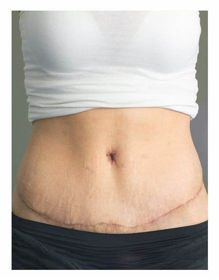 best tummy tuck in India